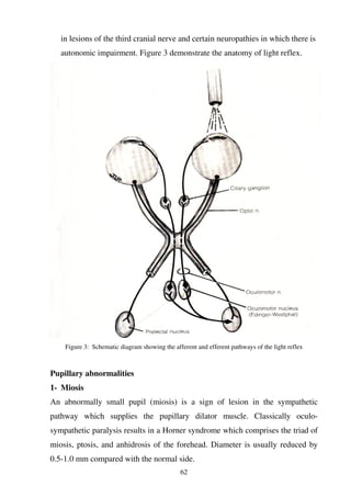 62
in lesions of the third cranial nerve and certain neuropathies in which there is
autonomic impairment. Figure 3 demonstrate the anatomy of light reflex.
Figure 3: Schematic diagram showing the afferent and efferent pathways of the light reflex
Pupillary abnormalities
1- Miosis
An abnormally small pupil (miosis) is a sign of lesion in the sympathetic
pathway which supplies the pupillary dilator muscle. Classically oculo-
sympathetic paralysis results in a Horner syndrome which comprises the triad of
miosis, ptosis, and anhidrosis of the forehead. Diameter is usually reduced by
0.5-1.0 mm compared with the normal side.
 
