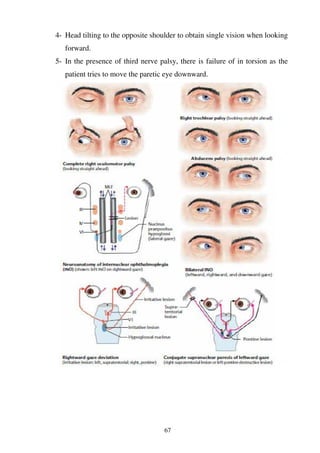 67
4- Head tilting to the opposite shoulder to obtain single vision when looking
forward.
5- In the presence of third nerve palsy, there is failure of in torsion as the
patient tries to move the paretic eye downward.
 