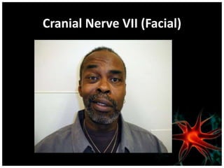 Cranial Nerve VII (Facial)
 