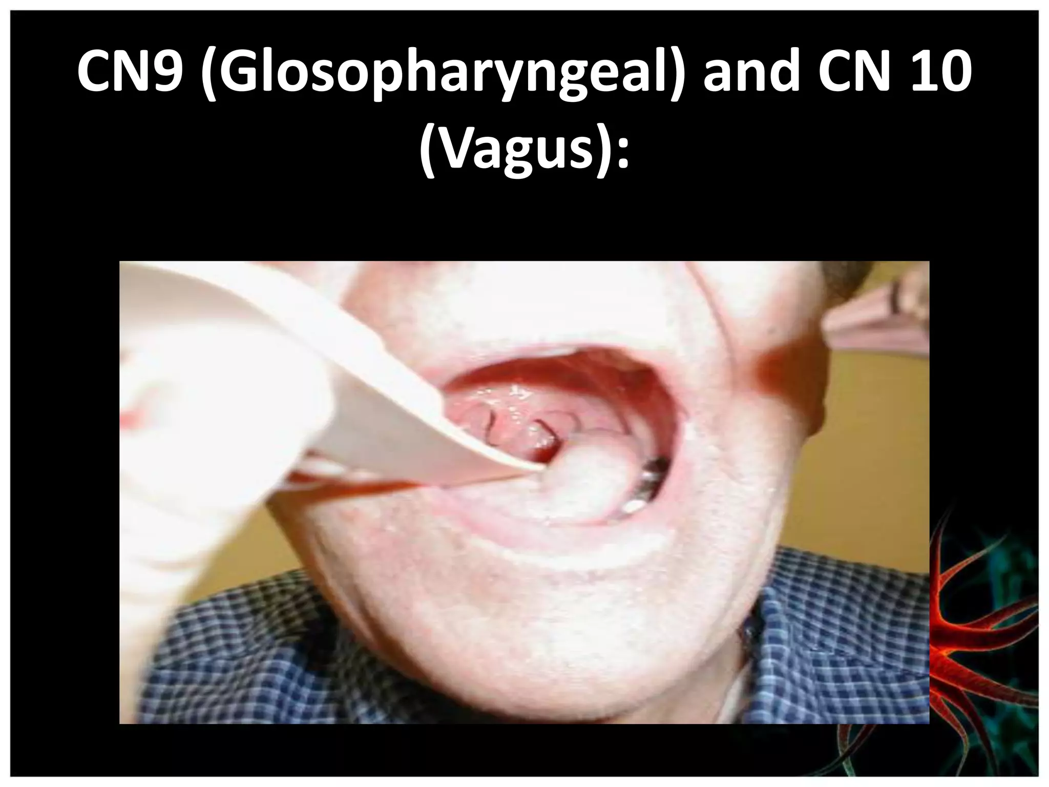 CN9 (Glosopharyngeal) and CN 10
           (Vagus):
 