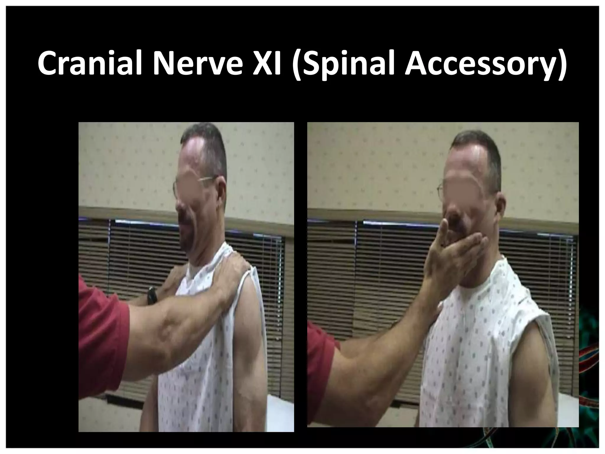 Cranial Nerve XI (Spinal Accessory)
 