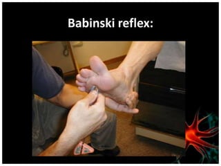 Babinski reflex:
 