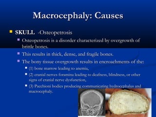 Macrocephaly: Causes
   SKULL -Osteopetrosis
       Osteopetrosis is a disorder characterized by overgrowth of
        brittle bones.
       This results in thick, dense, and fragile bones.
       The bony tissue overgrowth results in encroachments of the:
            (1) bone marrow leading to anemia,
            (2) cranial nerves foramina leading to deafness, blindness, or other
             signs of cranial nerve dysfunction,
            (3) Pacchioni bodies producing communicating hydrocephalus and
             macrocephaly.
 