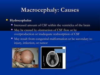 Macrocephaly: Causes
   Hydrocephalus 
     Increased amount of CSF within the ventricles of the brain

     May be caused by obstruction of CSF flow or by
      overproduction or inadequate reabsorption of CSF
     May result from congenital malformation or be secondary to
      injury, infection, or tumor
 