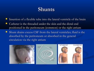 Shunts
   Insertion of a flexible tube into the lateral ventricle of the brain
   Catheter is the threaded under the skin and the distal end
    positioned in the peritoneum (common) or the right atrium
   Shunt drains excess CSF from the lateral ventricles; fluid is the
    absorbed by the peritoneum or absorbed in the general
    circulation via the right atrium
 