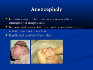 Anencephaly
   Defective closure of the rostral neural tube results in
    anencephaly or encephalocele
   Neonates with anencephaly have a rudimentary brainstem, or
    midrain , no cortex or cranium
   Rapidly fatal condition if born alive
 