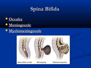 Spina Bifida
   Occulta
   Meningocele
   Myelomeningocele
 