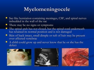 Myelomeningocele
   Sac-like herniation containing meninges, CSF, and spinal nerves
    imbedded in the wall of the sac
   There may be no signs or symptoms
   The spinal arch has not closed, but the spinal cord underneath
    has retained its normal position and is not damaged
   Skin of back intact, small dimple or tuft of hair may be present
    over affected vertebrae
   A child could grow up and never know that he or she has the
    defect
 