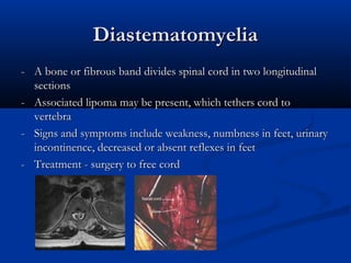 Diastematomyelia
- A bone or fibrous band divides spinal cord in two longitudinal
  sections
- Associated lipoma may be present, which tethers cord to
  vertebra
- Signs and symptoms include weakness, numbness in feet, urinary
  incontinence, decreased or absent reflexes in feet
- Treatment - surgery to free cord
 