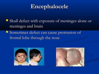 Encephalocele

   Skull defect with exposure of meninges alone or
    meninges and brain
   Sometimes defect can cause protrusion of
    frontal lobe through the nose
 