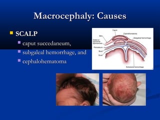 Macrocephaly: Causes
   SCALP
     caput succedaneum,
     subgaleal hemorrhage, and

     cephalohematoma
 