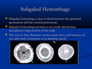 Subgaleal Hemorrhage
   Subgaleal hemorrhage is due to blood between the epicranial
    aponeurosis and the external periosteum.
   Subgaleal hemorrhage presents as an evenly spread mass
    throughout a large portion of the scalp.
   The mass is firm, fluctuant, crosses suture lines, and increases in
    size after birth (sometimes at an alarming speed)
 