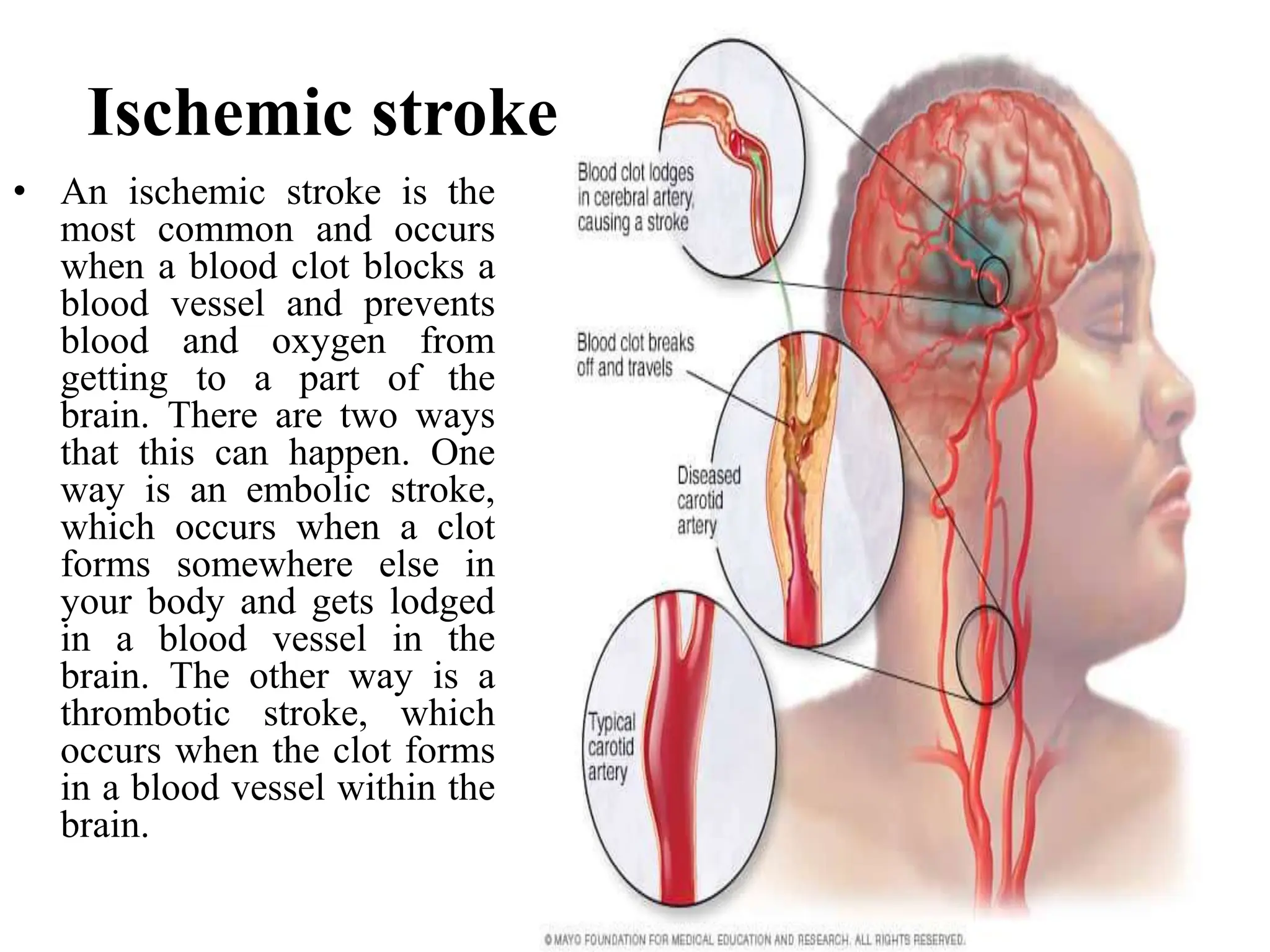 Ischemic stroke
• An ischemic stroke is the
most common and occurs
when a blood clot blocks a
blood vessel and prevents
blood and oxygen from
getting to a part of the
brain. There are two ways
that this can happen. One
way is an embolic stroke,
which occurs when a clot
forms somewhere else in
your body and gets lodged
in a blood vessel in the
brain. The other way is a
thrombotic stroke, which
occurs when the clot forms
in a blood vessel within the
brain.
 