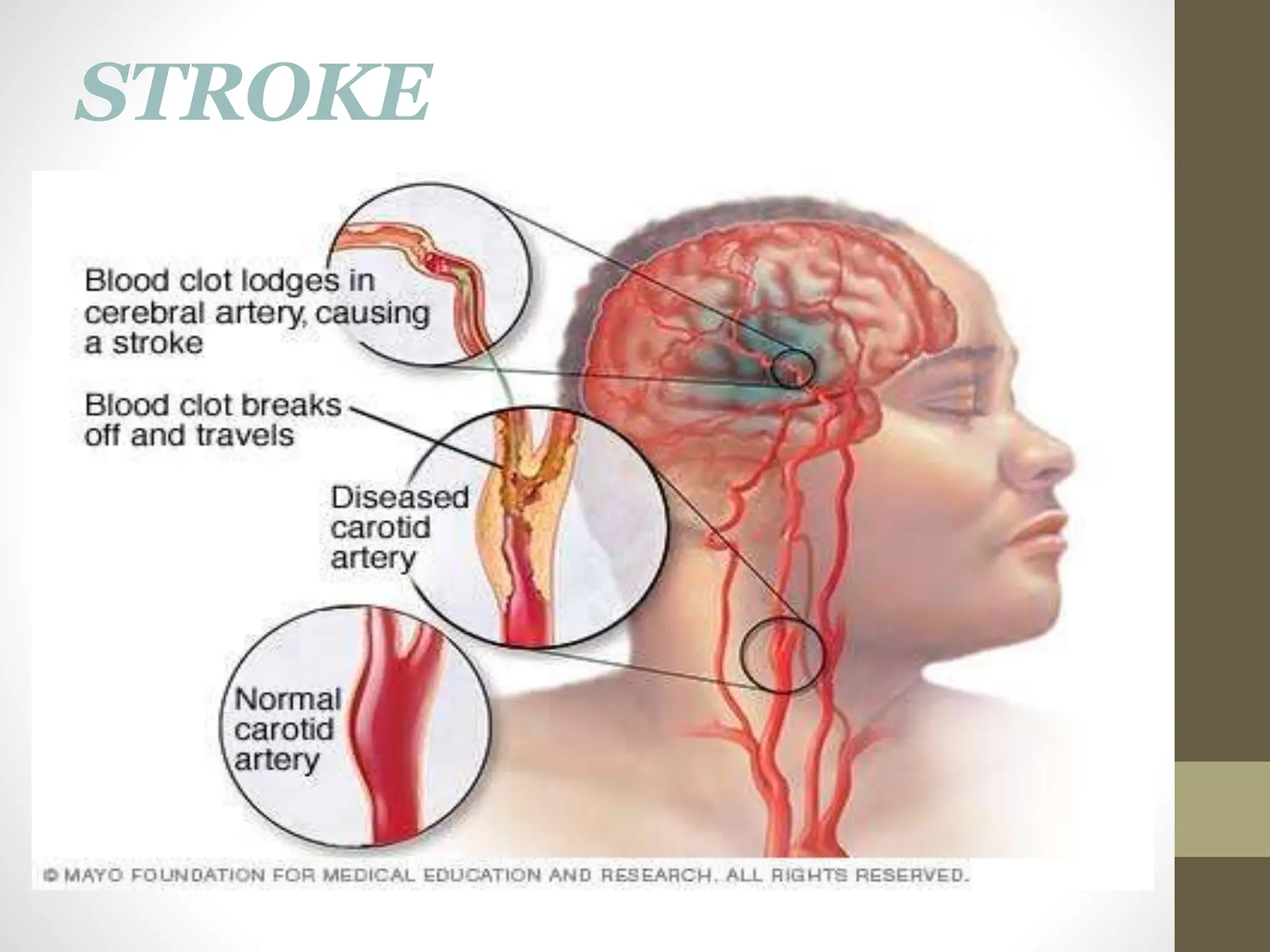 STROKE
 