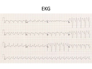 EKG
 