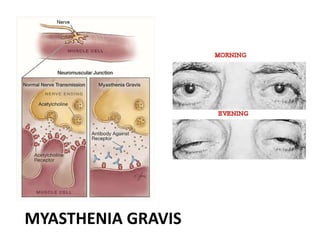 MYASTHENIA GRAVIS
 