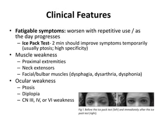 Clinical Features
• Fatigable symptoms: worsen with repetitive use / as
the day progresses
– Ice Pack Test- 2 min should improve symptoms temporarily
(usually ptosis; high specificity)
• Muscle weakness
– Proximal extremities
– Neck extensors
– Facial/bulbar muscles (dysphagia, dysarthria, dysphonia)
• Ocular weakness
– Ptosis
– Diplopia
– CN III, IV, or VI weakness
 