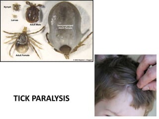 TICK PARALYSIS
 