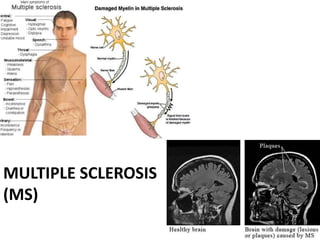 MULTIPLE SCLEROSIS
(MS)
 