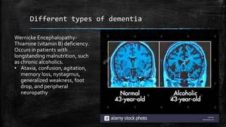 Different types of dementia
Wernicke Encephalopathy-
Thiamine (vitamin B) deficiency.
Occurs in patients with
longstanding malnutrition, such
as chronic alcoholics.
• Ataxia, confusion, agitation,
memory loss, nystagmus,
generalized weakness, foot
drop, and peripheral
neuropathy
 