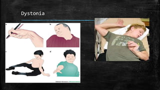 Dystonia
 