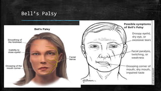 Bell’s Palsy
 