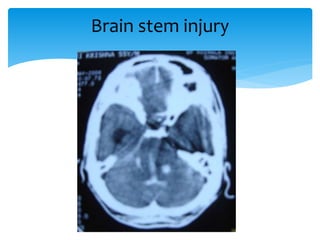 Brain stem injury
 