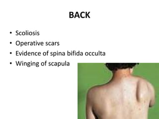 BACK
• Scoliosis
• Operative scars
• Evidence of spina bifida occulta
• Winging of scapula
4
 