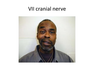 VII cranial nerve
 