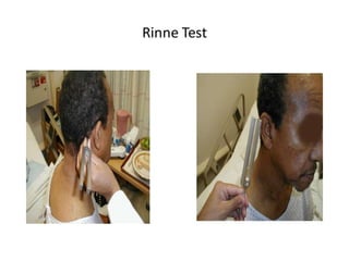Rinne Test
 