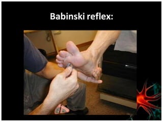Babinski reflex:
 