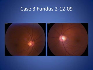 Case 3 Fundus 2-12-09
 
