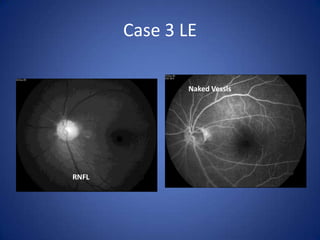 Case 3 LE

              Naked Vessls




RNFL
 