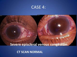 CASE 4:




Severe episcleral venous congestion
    CT SCAN NORMAL
 