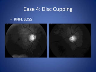 Case 4: Disc Cupping
• RNFL LOSS
 
