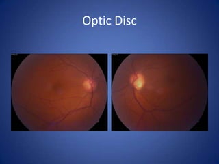 Optic Disc
 