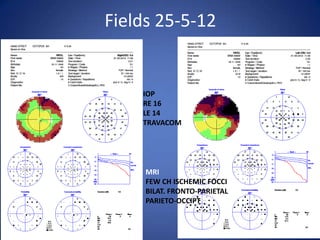 Fields 25-5-12


    IOP
    RE 16
    LE 14
    TRAVACOM




     MRI
     FEW CH ISCHEMIC FOCCI
     BILAT. FRONTO-PARIETAL
     PARIETO-OCCIPT
 