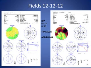 Fields 12-12-12

     IOP
     RE 13
     LE 15

     TRAVACOM

     ADD BRIMO
 