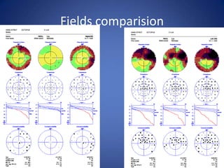 Fields comparision
 
