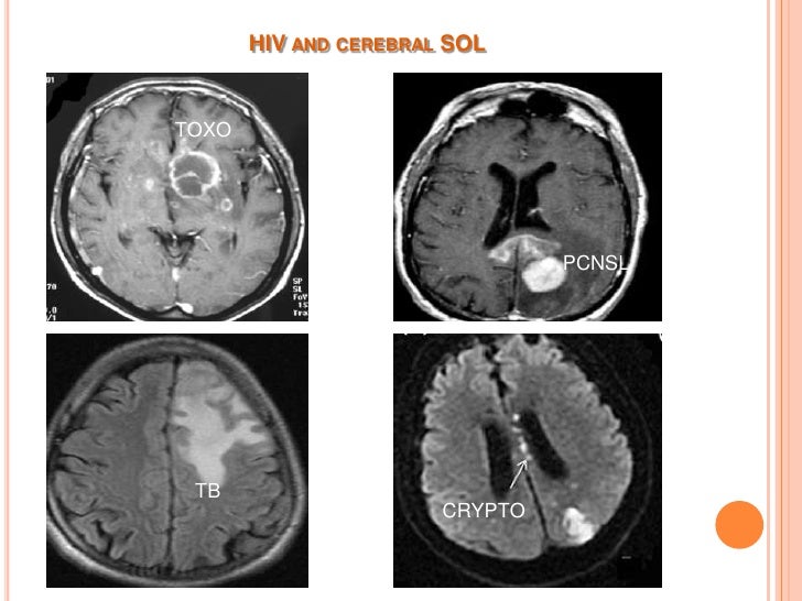 Neurological manifestations of HIV/AIDS 2012