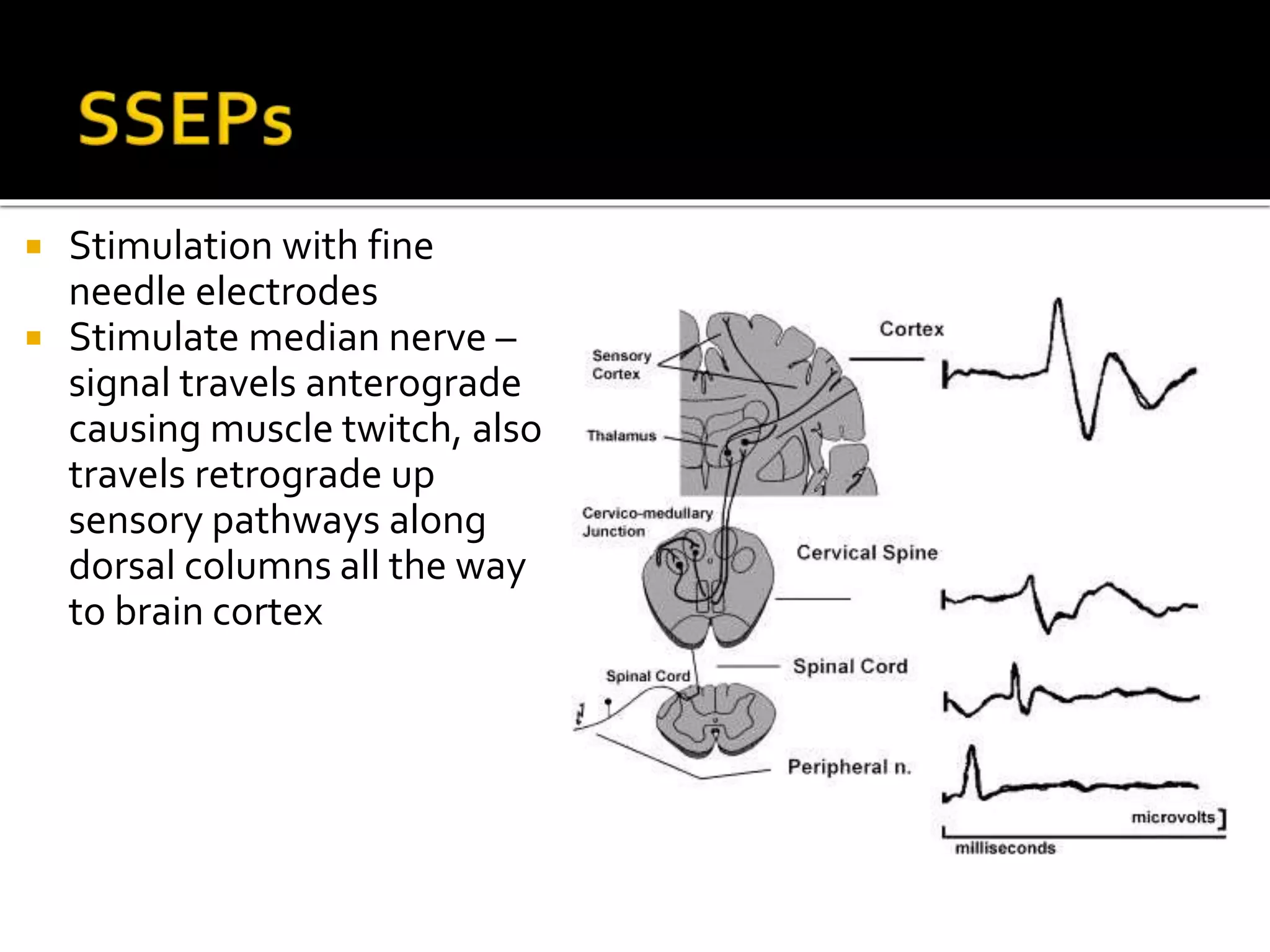  Stimulation with fine
needle electrodes
 Stimulate median nerve –
signal travels anterograde
causing muscle twitch, also
travels retrograde up
sensory pathways along
dorsal columns all the way
to brain cortex
 