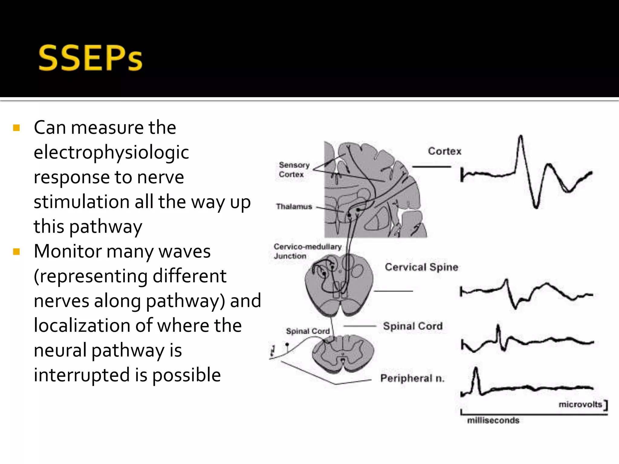  Can measure the
electrophysiologic
response to nerve
stimulation all the way up
this pathway
 Monitor many waves
(representing different
nerves along pathway) and
localization of where the
neural pathway is
interrupted is possible
 