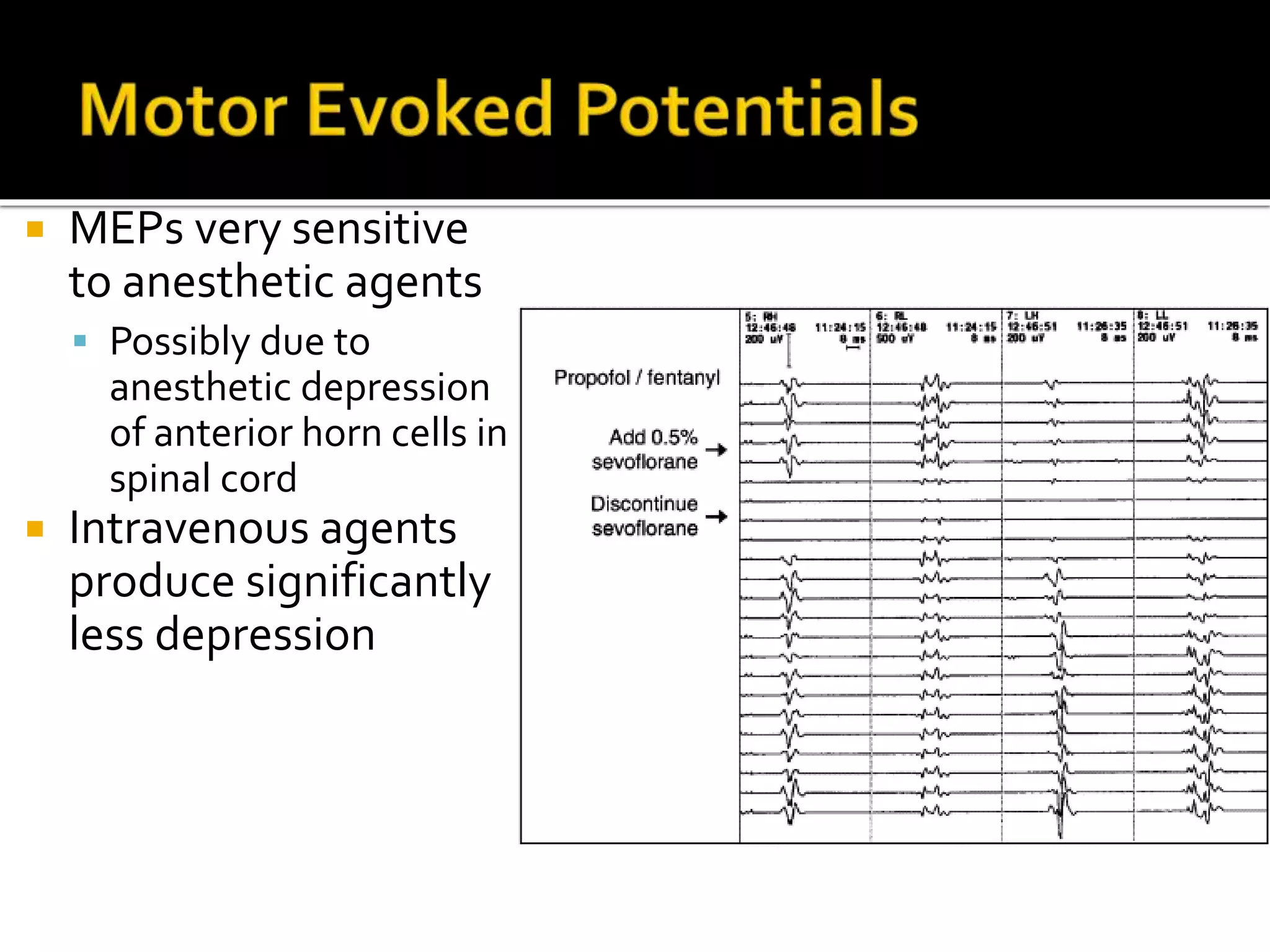  MEPs very sensitive
to anesthetic agents
 Possibly due to
anesthetic depression
of anterior horn cells in
spinal cord
 Intravenous agents
produce significantly
less depression
 