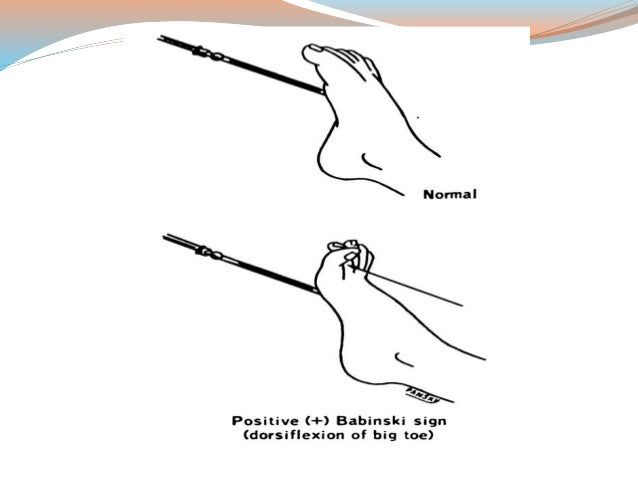 Neurological Signs In Medicine Neurological Signs In Medicine