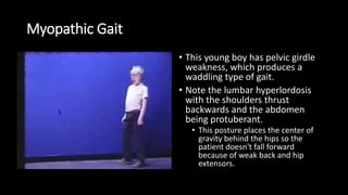 Myopathic Gait
• This young boy has pelvic girdle
weakness, which produces a
waddling type of gait.
• Note the lumbar hyperlordosis
with the shoulders thrust
backwards and the abdomen
being protuberant.
• This posture places the center of
gravity behind the hips so the
patient doesn't fall forward
because of weak back and hip
extensors.
 