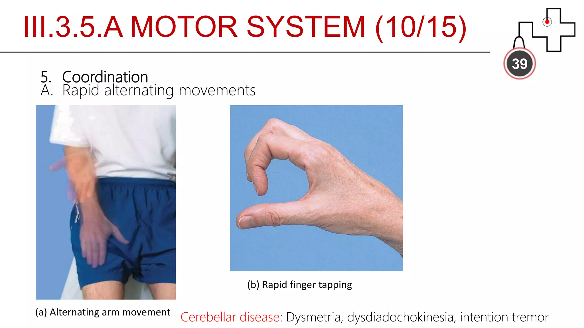 III.3.5.A MOTOR SYSTEM (10/15)
39
5. Coordination
A. Rapid alternating movements
(a) Alternating arm movement
(b) Rapid finger tapping
Cerebellar disease: Dysmetria, dysdiadochokinesia, intention tremor
 