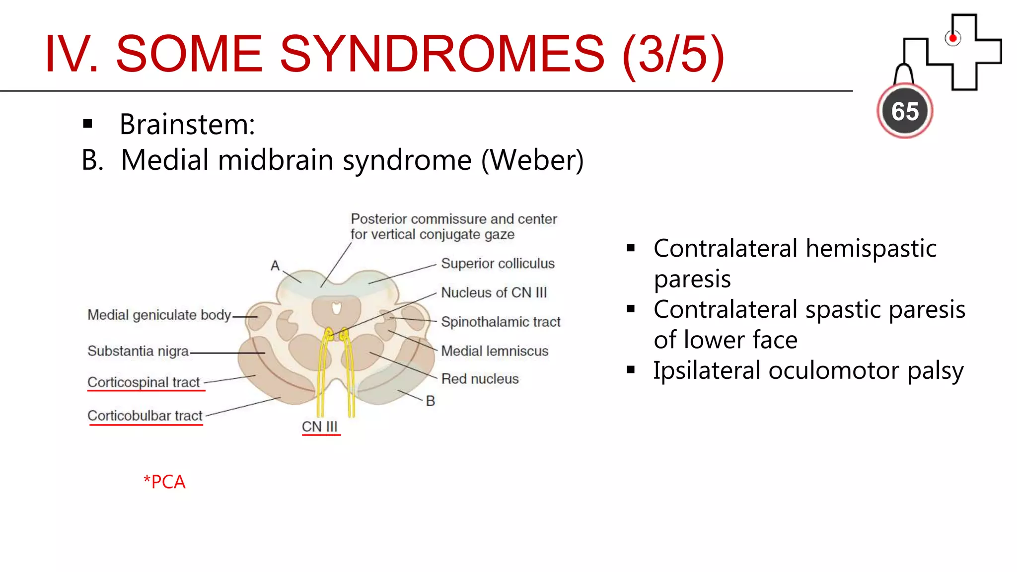 IV. SOME SYNDROMES (3/5)
65
 Brainstem:
B. Medial midbrain syndrome (Weber)
 Contralateral hemispastic
paresis
 Contralateral spastic paresis
of lower face
 Ipsilateral oculomotor palsy
*PCA
 