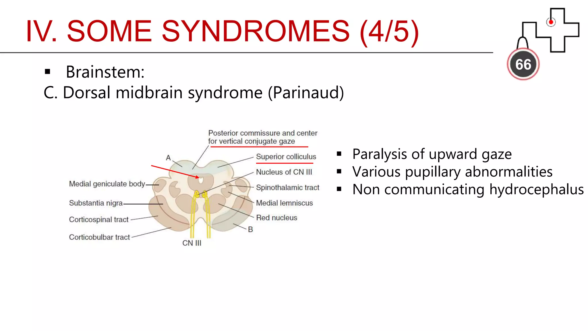 IV. SOME SYNDROMES (4/5)
66
 Brainstem:
C. Dorsal midbrain syndrome (Parinaud)
 Paralysis of upward gaze
 Various pupillary abnormalities
 Non communicating hydrocephalus
 