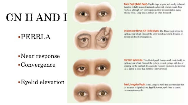Perrla Example How To Test Perrla โ What Is the PERRLA Eye Assessment? โ OEJBAQ