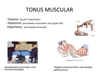 TONUS MUSCULAR
- Volume: Atrofia? Hipertrofia?
- Hipotonia: passividade aumentada- fase aguda AVE
- Hipertonia: passividade diminuida
-Espasticidade (piramidal): sinal
canivete;hemiplegia
-Rigidez (extrapiramidal): roda dentada;
parkinsonismo
 